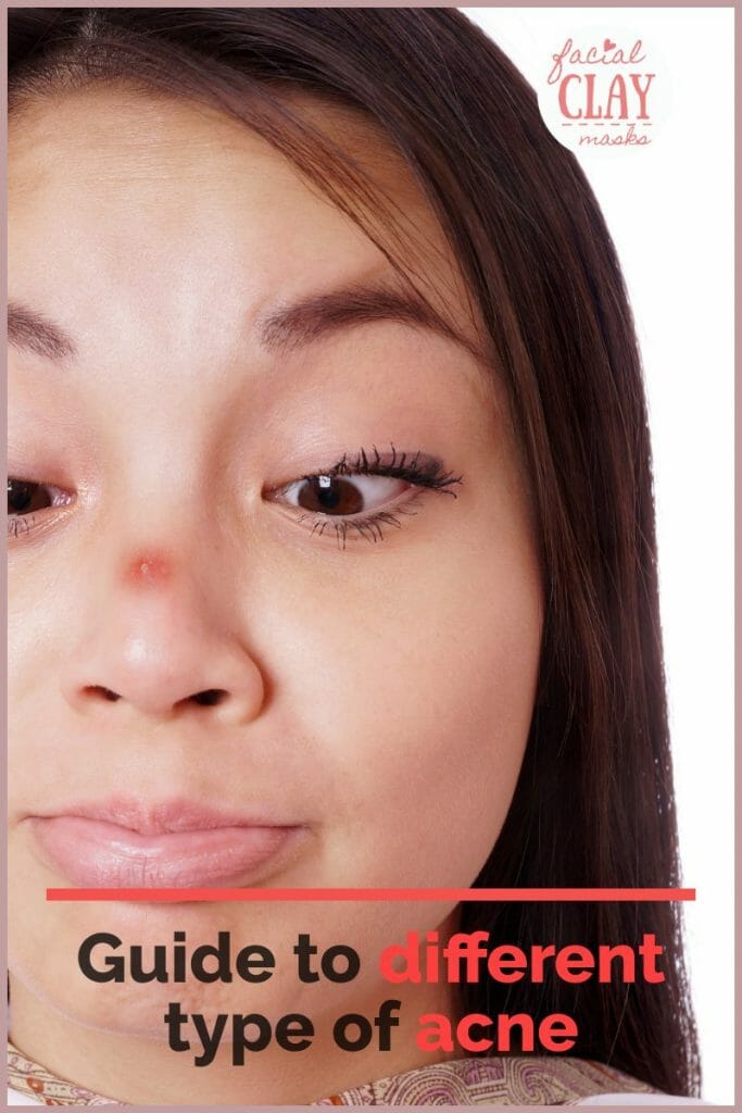 Acne 101: What are the Different Types of Acne?