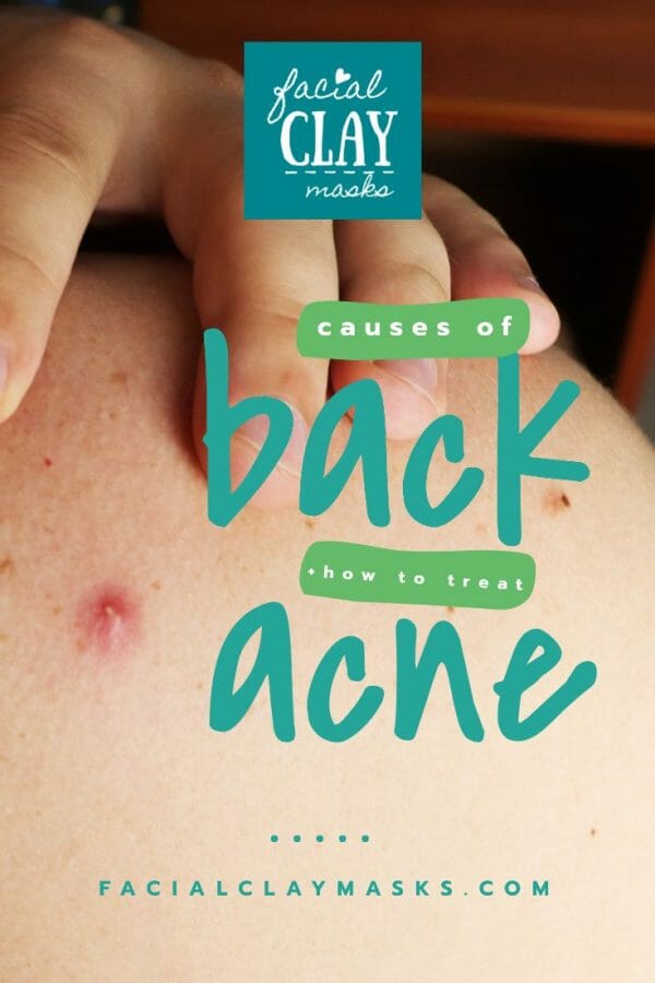 What are the Causes of Back Acne? + How to Treat Back Acne